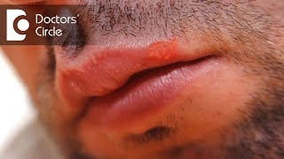What can cause a lip blister and its management? - Dr. Sachith Abraham