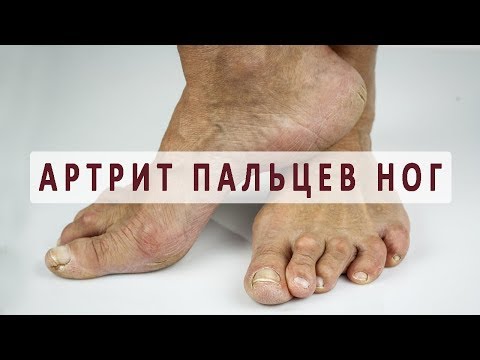 Реабилитация после перелома голеностопный сустав Артрит межфаланговых суставов ноги