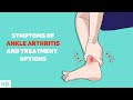 Don't Ignore Your Ankle Pain: Understanding Ankle Arthritis