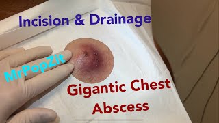Giant inflamed abscess on chest. Incision &amp; drainage. So much inside that comes out! Pressure relief