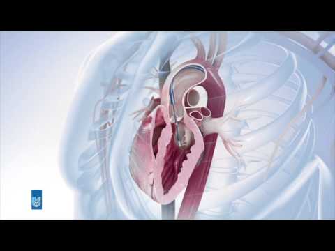 Minimalinvasive Herzklappenchirugie/ TAVI am Herzzentrum Zürich