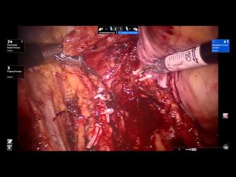 Robotic Radical Cystoprostatectomy with Simultaneous Urethrectomy, Cutaneous Uretersotomy