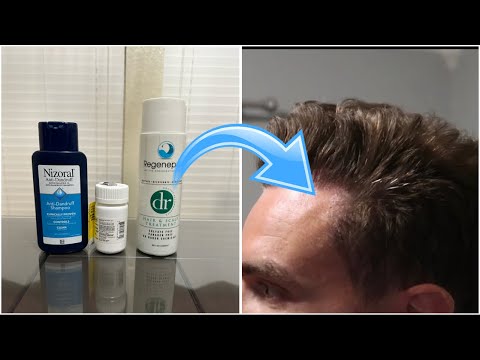 My current Hair Loss Stack! How I stopped my Hair loss!