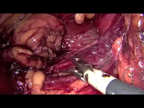 Laparoscopic Radical Nephrectomy - Identifying The Ureter