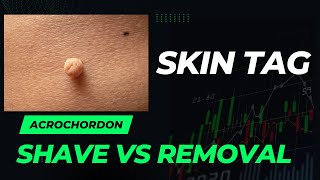 Skin Tag (Acrochordon) | Difference between Shave biopsy & Shave removal | 11200/11201 |11301 series