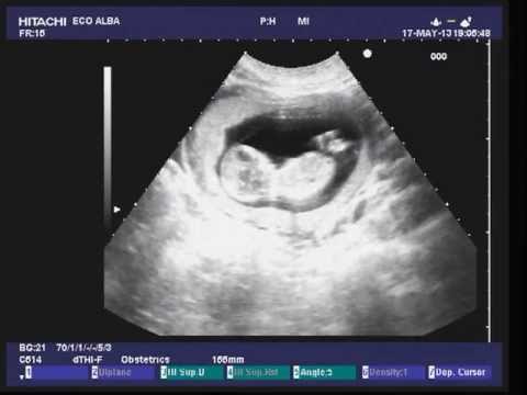 Vita dolente e testicolo gonfio Per forum sostituzione del ginocchio