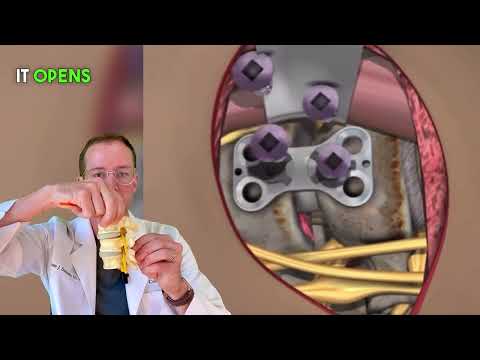 𝐖𝐡𝐚𝐭 𝐢𝐬 𝐚𝐧 𝐀𝐂𝐃𝐅? (𝚂𝚙𝚒𝚗𝚎 𝚂𝚞𝚛𝚐𝚎𝚘𝚗 𝙴𝚡𝚙𝚕𝚊𝚒𝚗𝚜)