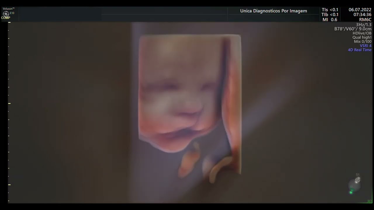 Ultrassom 4D HD Live - 03