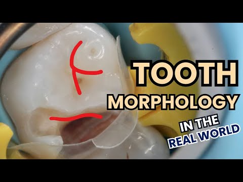 Should our Restorations Follow Textbook Anatomy? Tooth Morphology - PS005