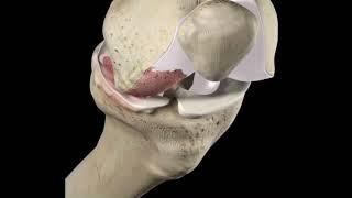 ¿QUÉ ES EL EDEMA ÓSEO CAUSAS Y TRATAMIENTO