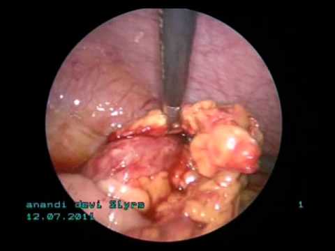 laparoscopic  management of early appendicular lump