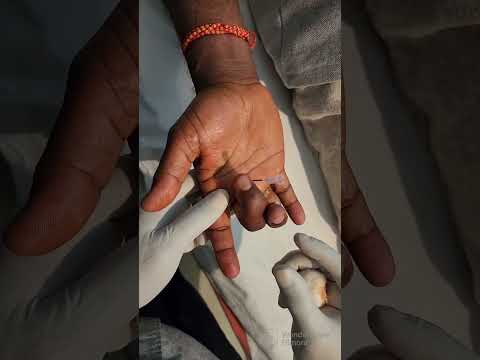 Trigger finger - Percutaneous release| Dr Birendra Kumar | Easy ortho