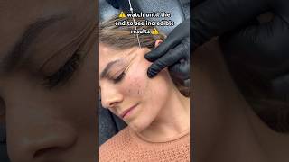 ‼️ TW ‼️ Would you try a thread lift? 👀 Results at the end! #threadlift #threads #beauty