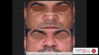 Acne Scar Treatment: Taylor Liberator + Fat Grafting