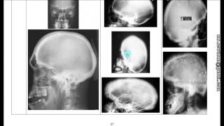 Dr.Mahmoud Sewilam, Bone X-Rays