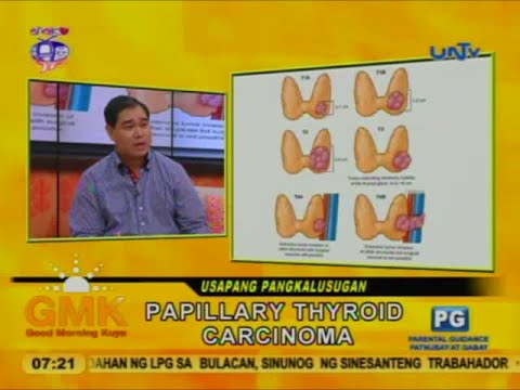 Laryngeal papilloma incidence