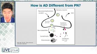 Neuroimmune Underpinnings of Prurigo Nodularis