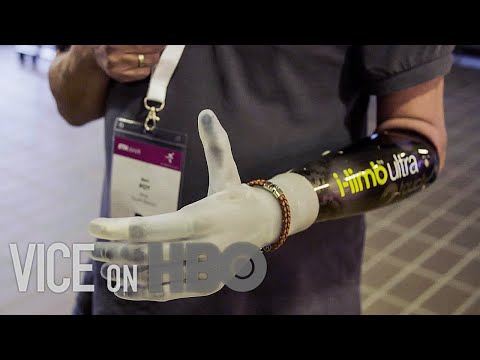 These Bionic Limbs Are Assisting People with Disabilities