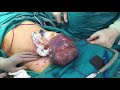 Borderline Tumor Of The Ovary