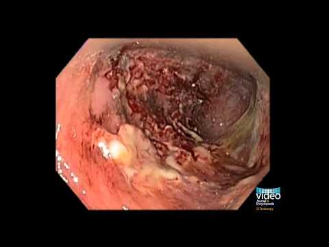 Diversion Colitis