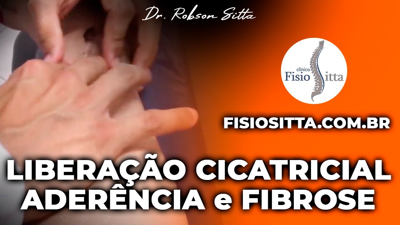 MASSAGEM de LIBERAÇÃO CICATRICIAL PREVENÇÃO ADERÊNCIA FIBROSE Clínica Fisioterapia Dr. Robson Sitta