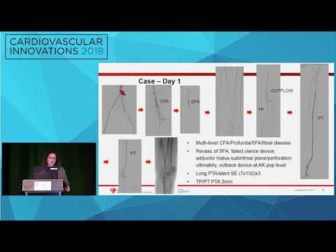 CVI2018 Session: My worst tibial complication - Karem Harth, MD
