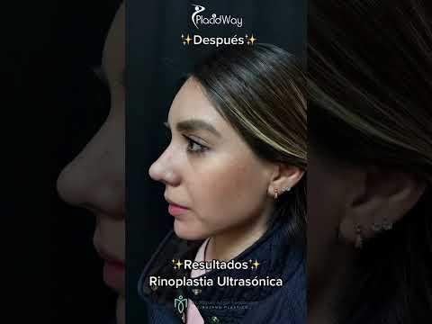 Refine Your Radiance: Before and After Rhinoplasty in Mexicali, Mexico at Dr. Miguel Angel Fernandez