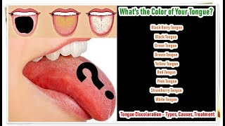 Tongue Discoloration – Types, Causes, Treatment