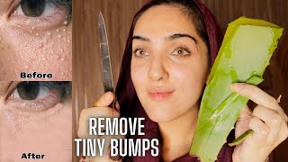 HOW TO REMOVE TINY BUMPS ON YOUR FACE! *They
