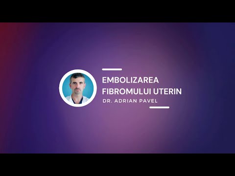 Embolizarea fibromului uterin - Dr. Adrian Pavel