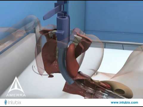 Intubix Endotracheal Tube Holder - 3D Medical Device Animation