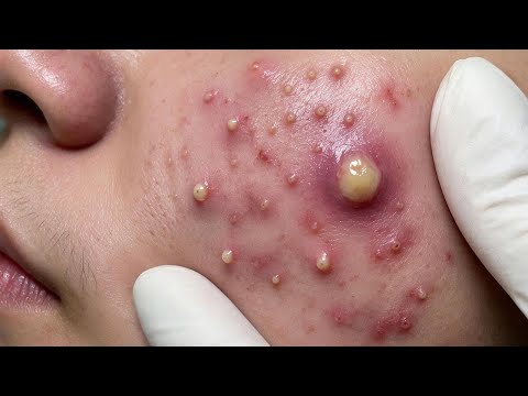 Pimple Popping Spa