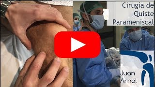 Menisco Roto con Quiste Parameniscal: Cirugía por Artroscopia