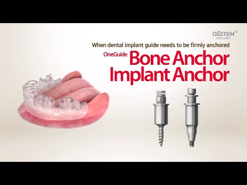 Anchors the OneGuide in place and prevents the OneGuide from shaking “OneGuide Vertical Anchor”