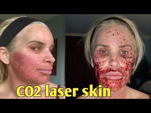 7-Day Journey My CO2 Laser Skin Resurfacing Experience – Before and after.. chris link