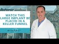 Watch This Large Implant Be Placed In A Keller Funnel