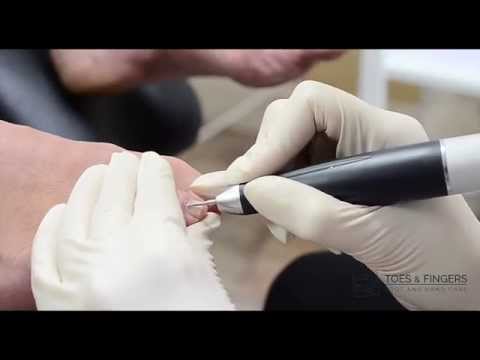 Dry Waterless Machine Pedicure Treatment - Prd by Toes & Fingers in Ireland, Dublin