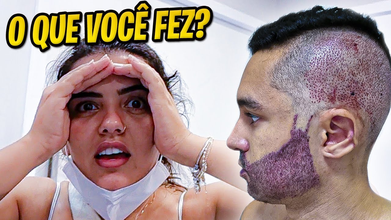OLHA COMO EU FIQUEI APÓS O TRANSPLANTE DE BARBA (A BRUNA TÁ MUITO ASSUSTADA)