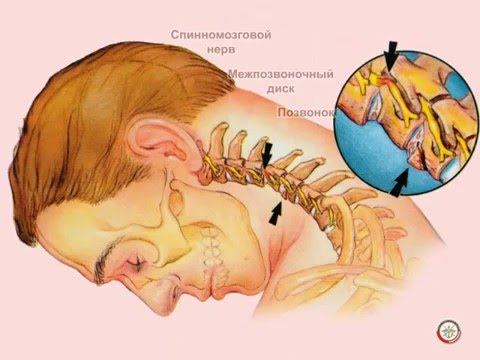 Лечение сужения поясничного отдела спинномозгового канала Почему болит вниз шеи