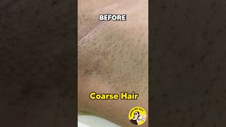 BEFORE &amp; AFTER: LASER HAIR REMOVAL RESULTS😨🤗 #laser #laserhairremoval #beforeandafter