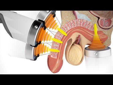 Shockwave Therapy For Erectile Dysfunction