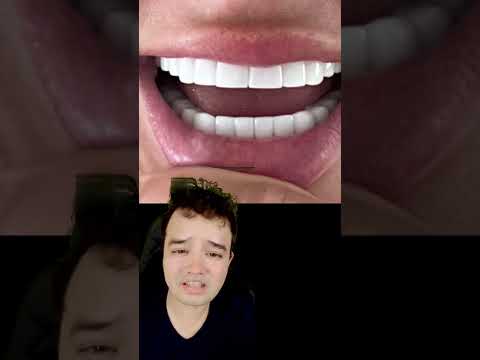 As facetas de porcelana dela deram MUITO ERRADO #shorts