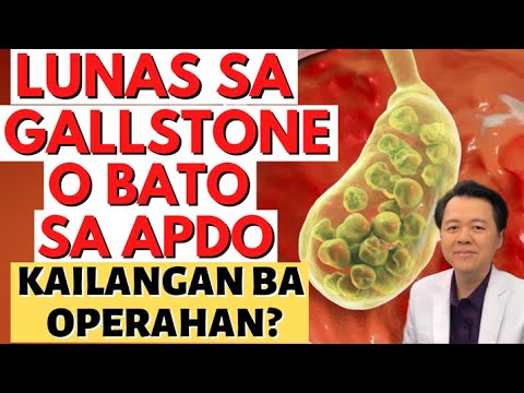 Lunas sa Gallstone o Bato sa Apdo. - By Doc Willie Ong (Internist and Cardiologist)