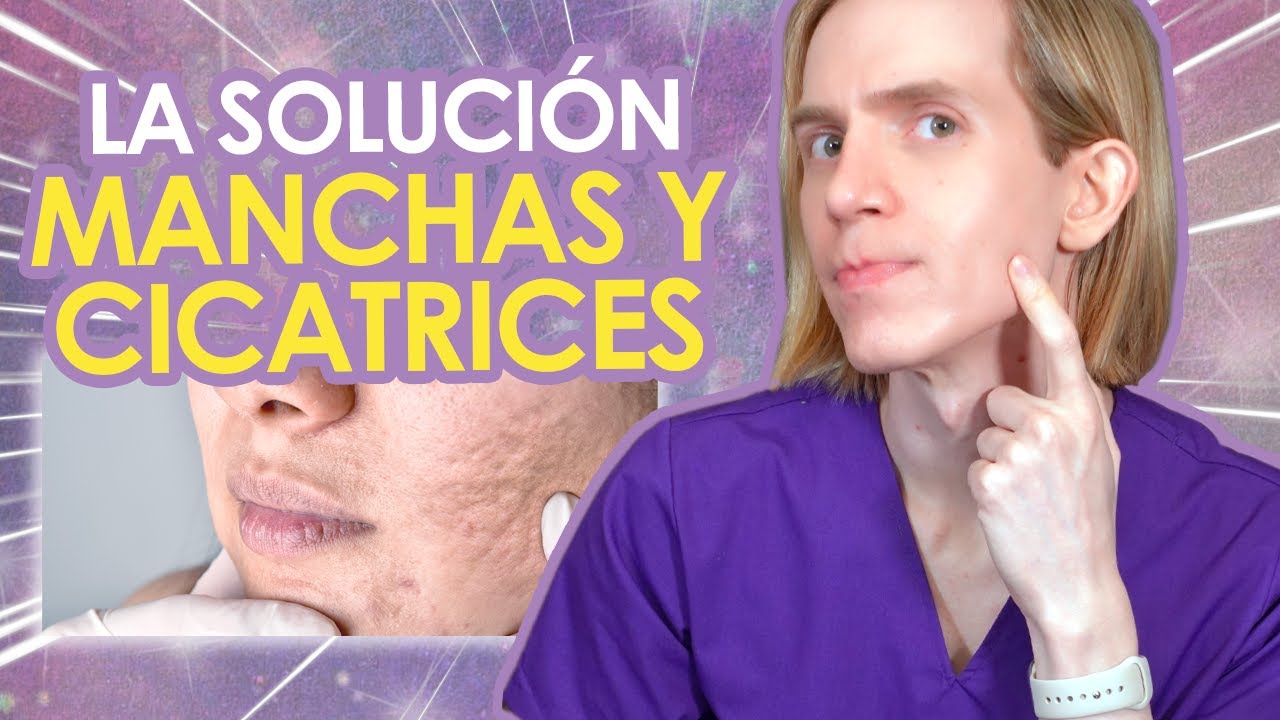 COMO BORRAR MANCHAS Y CICATRICES DE ACNE - Guia paso a paso y guia de productos - Simon Scarano