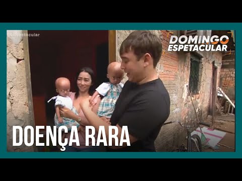 Identical twins have a rare syndrome that accelerates aging by up to seven times.