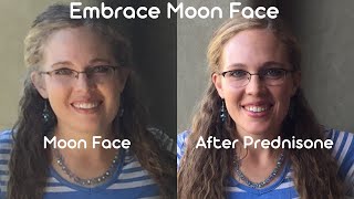 Embrace Moon Face - Prednisone Side Effect Inspiration