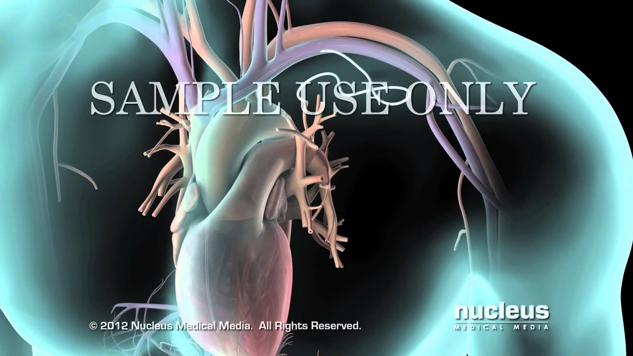 Watch Desfibrilador cardioversor implantable (ICD) Now Desfibrilador cardioversor implantable (ICD)