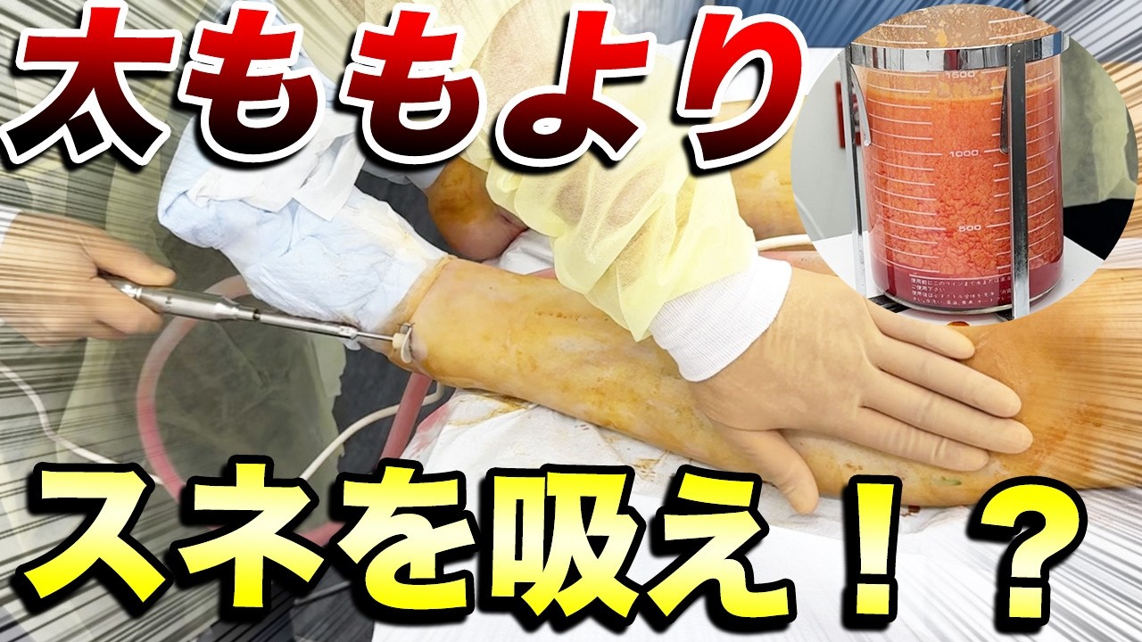 【新常識】太ももより「スネ」を吸うべき理由。1,300cc吸引で判明した、脚を劇的に細く見せる「前面」の重要性【脚痩せ】