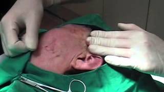 Thread Lift Aesthetic Surgery Procedure; Face Lift_New (フェイスリフティングスレッド )