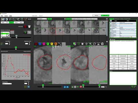 suiteHEART Version 5 0 1 Flow Analysis Demonstration Video NS 03 000 0001 Rev1